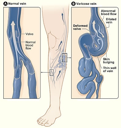 Varicose_veins