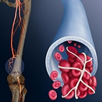deep vein thrombosis