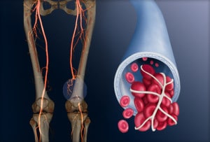 Thrombolysis