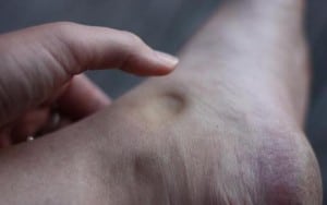 Ankle and Leg Swelling (Edema)