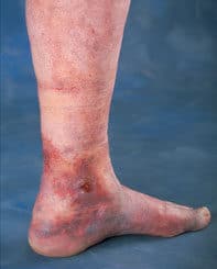 Leg Ulcer 