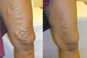 varicose veins before and after