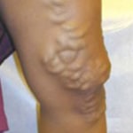 microphilebectomy treatment