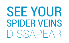 See Your Spider Veins Dissapear