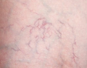 Spider Veins