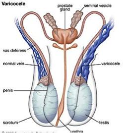 varicose vein of the testicle and scrotum that may cause pain and lead to testicular atrophy (shrinkage of the testicles)
