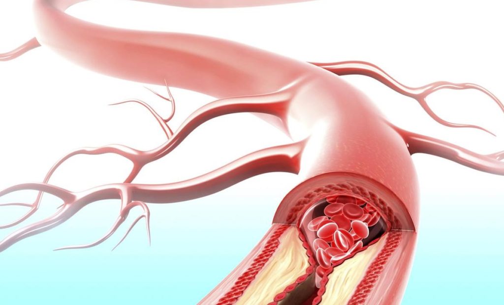 Artery with plaque inside 