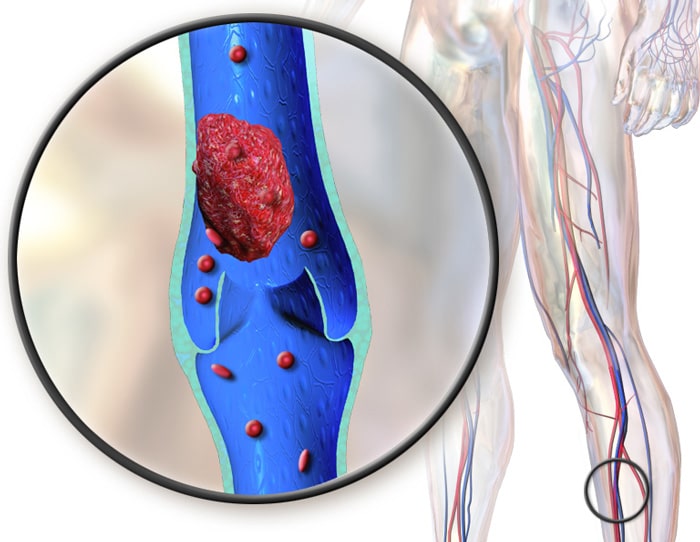 Blood clot in the leg DVT