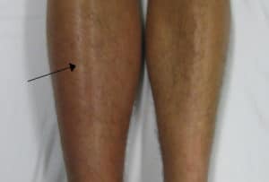 Blood Clot in the Leg Swelling