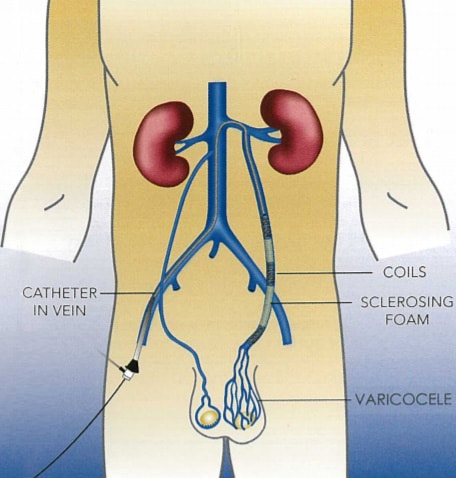 Varicocele