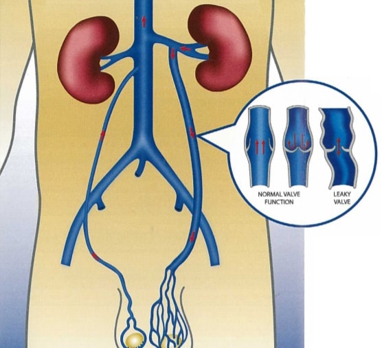 Varicocele Testicle Pain