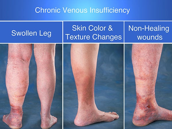 Chronic-Venous-Insufficiency-Legs