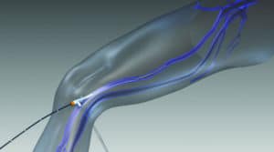 ClosureFast Endovenous Radiofrequency Ablation Dallas TX