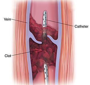 Catheter is inserted in vein through blood clot. 