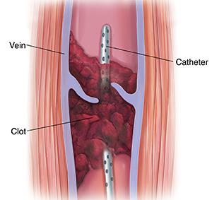 How Is Deep Vein Thrombosis Treated?