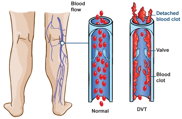 Normal Blood Flow Diagram | Detached Blood Clot Diagram | DVT Causes