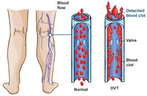 as vein disease progresses, varicose veins enlarge become more prominent. Valves & veins walls become more damaged