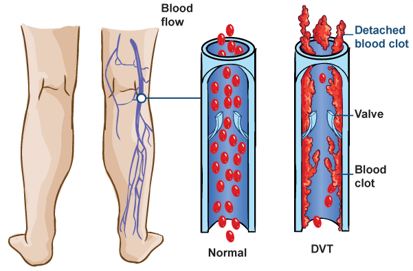 Deep Vein Thrombosis DVT | Dallas Fort Worth TX