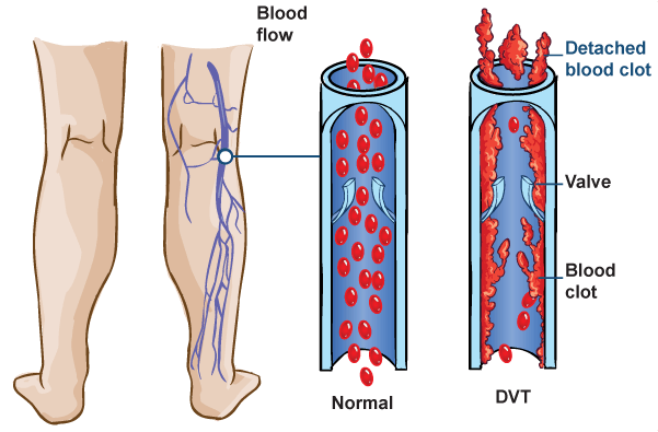 Deep Vein Thrombosis