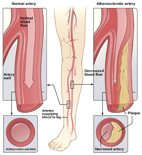 Drug-Eluting Balloons to Treat Peripheral Arterial Disease (PAD)