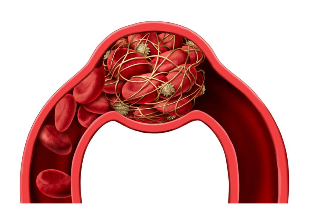 Cholesterol plaque in artery