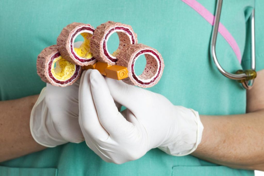 High cholesterol atherosclerosis build up plaque