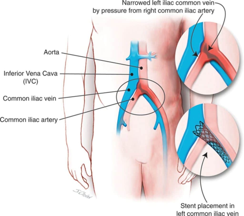 May-Thurner Syndrome Stent and Angioplasty