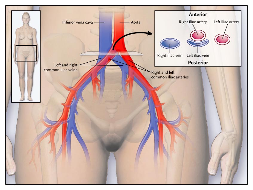 Causes and Prevalence of the May-Thurner Syndrome