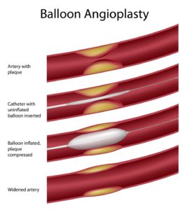 Peripheral Artery Disease - PAD Angioplasty Balloon