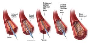 PAD Metal Stent