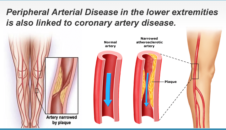 PAD Causes: Peripheral Arterial Disease in the lower extremities is also linked to coronary artery disease.