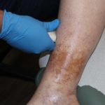 Pain Free Legs Dallas Scan