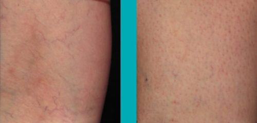 Patient-Before-After-Photos_Sider-Veins_Patient1