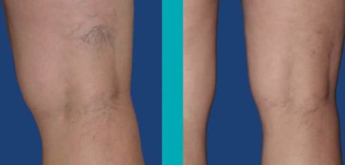 Patient-Before-After-Photos_Sider-Veins_Patient2