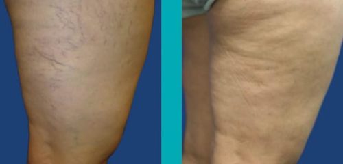 Patient-Before-After-Photos_Sider-Veins_Patient3