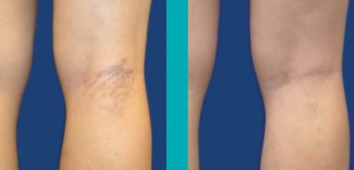 Patient-Before-After-Photos_Sider-Veins_Patient4