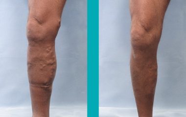 Patient Before and After Vein Treatment Photos