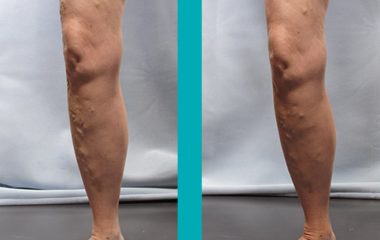 Patient Before and After Vein Treatment Photos