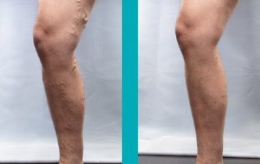 Patient Before and After Vein Treatment Photos