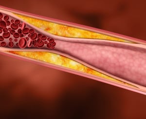 Peripheral Artery Disease PAD develops most commonly as a result of atherosclerosis
