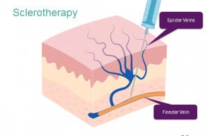 Sclerotherapy