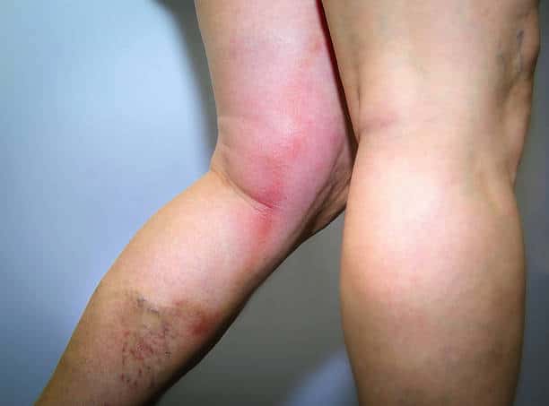 Thrombophlebitis