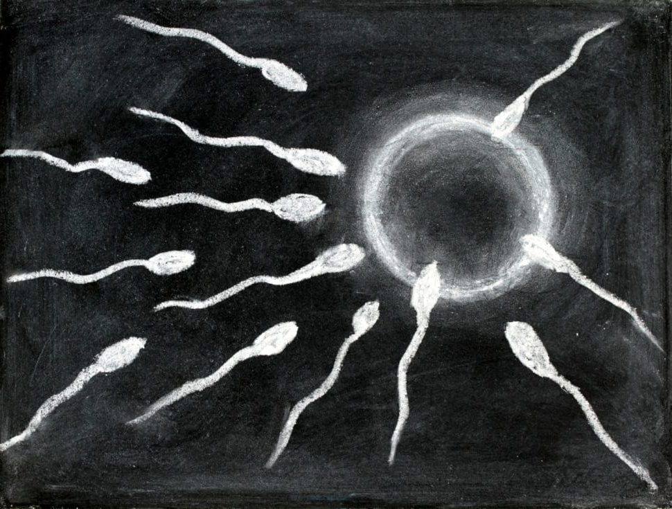 Varicoceles and Male Infertility