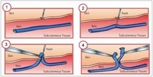 Phlebectomy (removing the varicose veins)