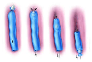 Traditional vein stripping surgery