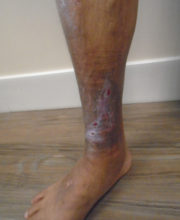 Vein-Treatment-Patient01-After