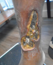 Vein-Treatment-Patient01-Before