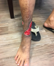 Vein-Treatment-Patient01-Mid