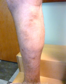 Vein-Treatment-Patient02-After
