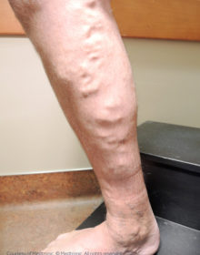 Vein-Treatment-Patient02-Before